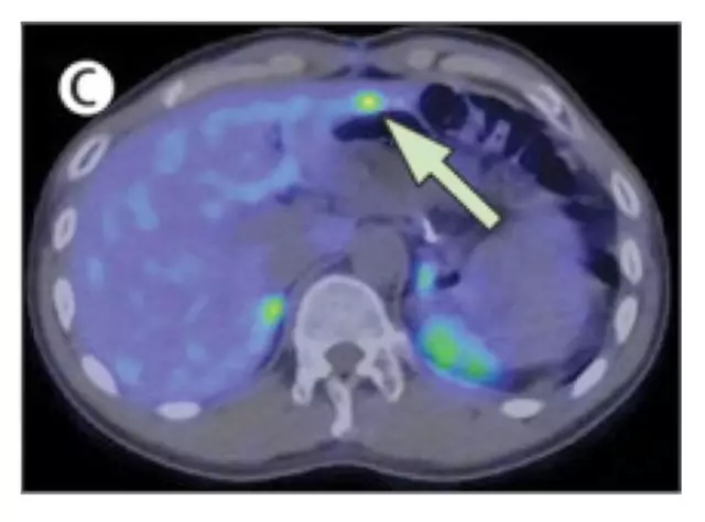 Saratani Katika Paka - Sio Misa Zote Zenye Giza Ni Tumors Za Saratani - Saratani Katika Pets